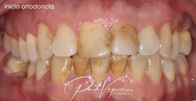 Ortodoncia invisible: antes del tratamiento