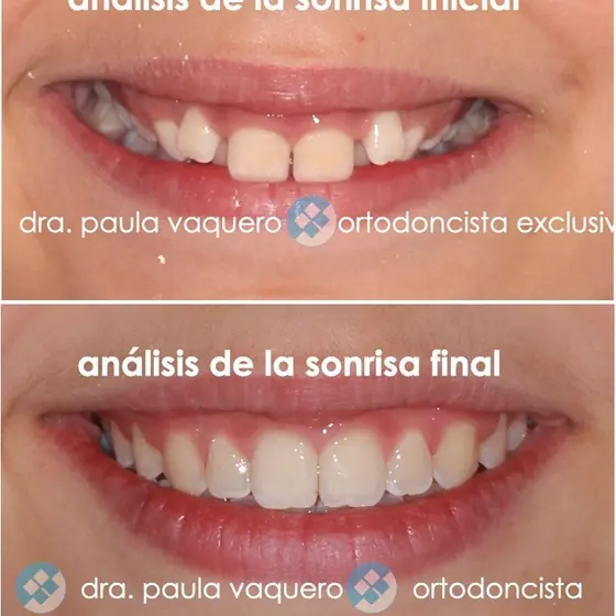 Análisis de la sonrisa inicial y final: cierre de diastema
