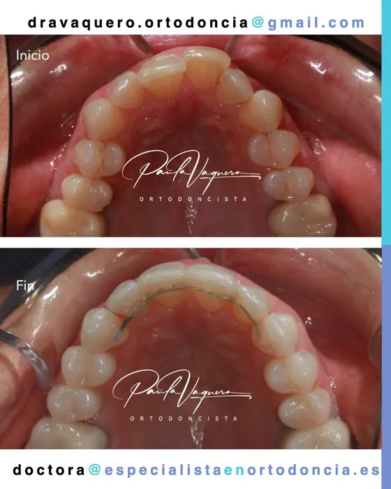 Vista oclusal antes y después, con retenedor fijo