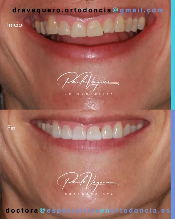 Sonrisa de paciente adulta antes y después del tratamiento